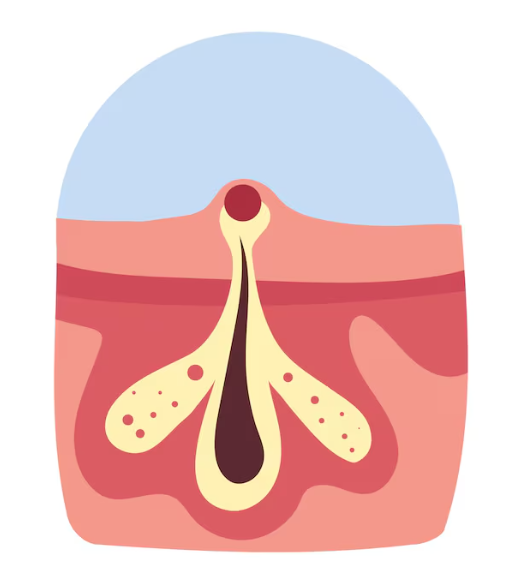 無創清粉刺價位與流程介紹|清潔、代謝、舒緩一次完成